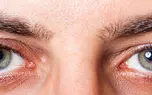 بسیاری از افراد دچار خشکی چشم می شوند، اما معمولاً خشکی چشم بیماری وخیمی...